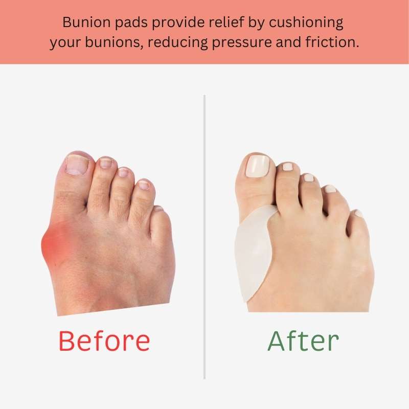 before and after the use of bunion pad